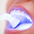 blanqueamientos dentales