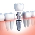 implantes dentales